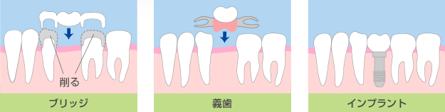 歯を失った場合の治療法：ブリッジ・義歯・インプラント